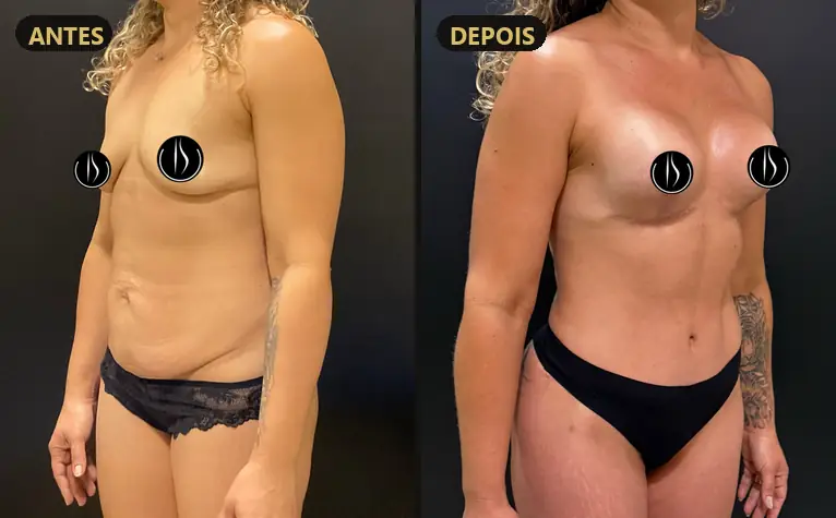Resultado: Mastopexia com prótese, lipoescultura e abdômen
