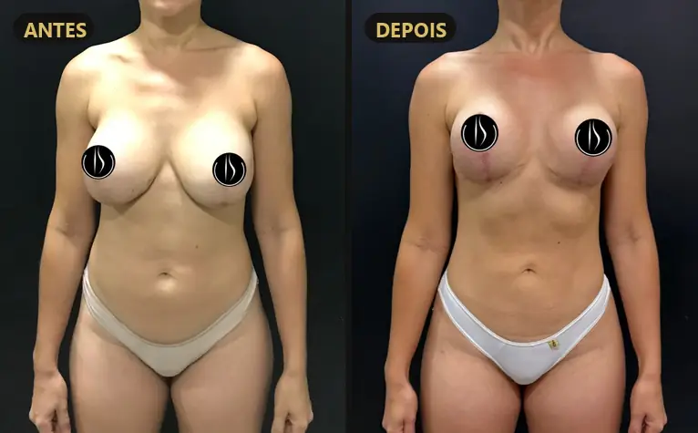 Resultado: Mastopexia com prótese e lipoescultura