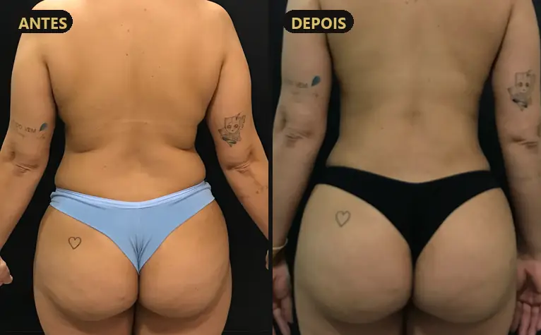 Resultado: Cirurgia combinada de tronco